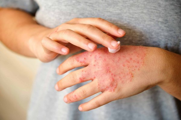 Top Home Remedies to Soothe Eczema Flare-Ups Naturally: Your Ultimate Guide